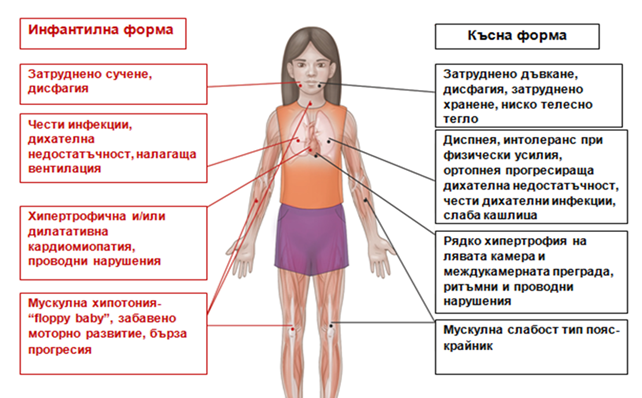 Клинични прояви при болестта на Помпе